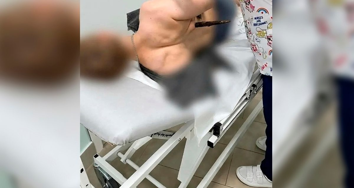 В Череповце врачи спасли 18-летнего пациента после сквозного ранения груди веткой